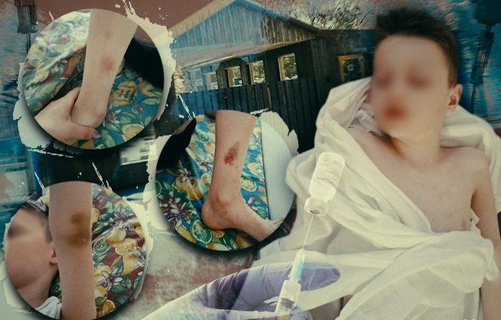 Отдых обернулся больницей: 8-летний мальчик попал на операционный стол после поездки в волгоградский лагерь