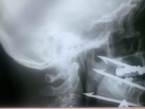 В Волгограде врачи спасли рыбака с гарпуном, застрявшим в миллиметре от сонной артерии