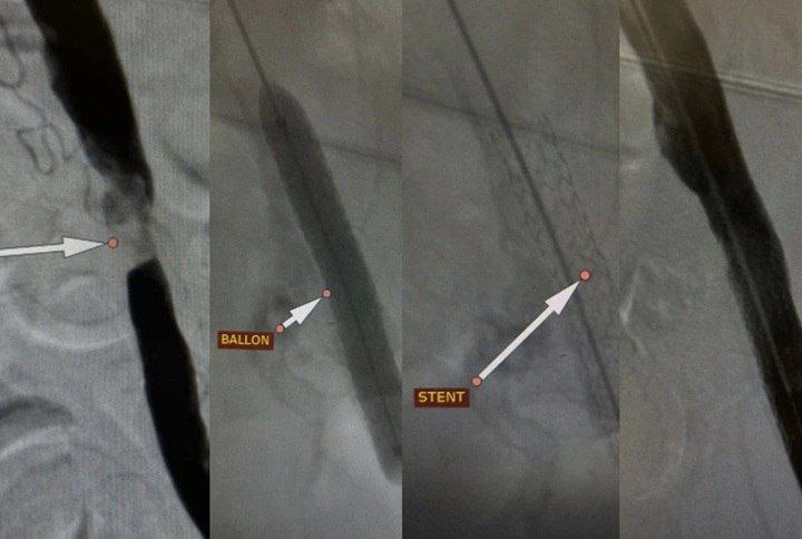 Через один прокол: в Волгограде хирурги совершили операцию, вернувшую пациенту возможность ходить