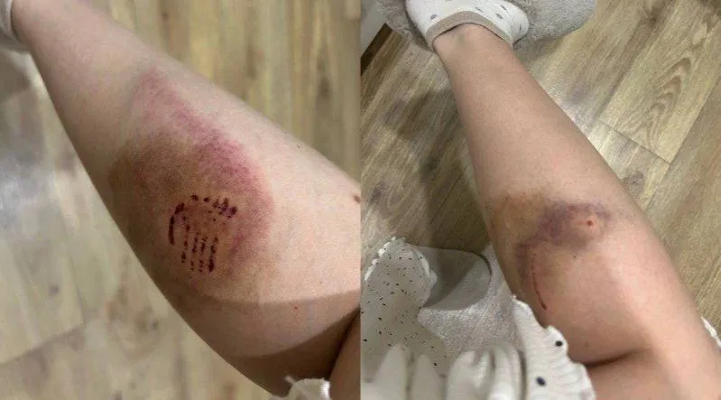 Бродячие собаки напали на 25-летнюю женщину в Кировском районе Волгограда