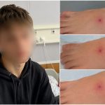 Седьмой случай в регионе: школьник оказался в реанимации после укуса ядовитого паука